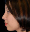 Rhinoplasty case #12754