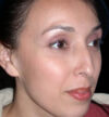 Rhinoplasty case #12754