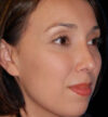 Rhinoplasty case #12754