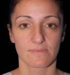 Rhinoplasty case #12747