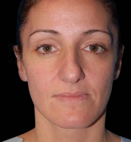 Rhinoplasty case #12747