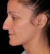 Rhinoplasty case #12747