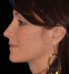 Rhinoplasty case #12747