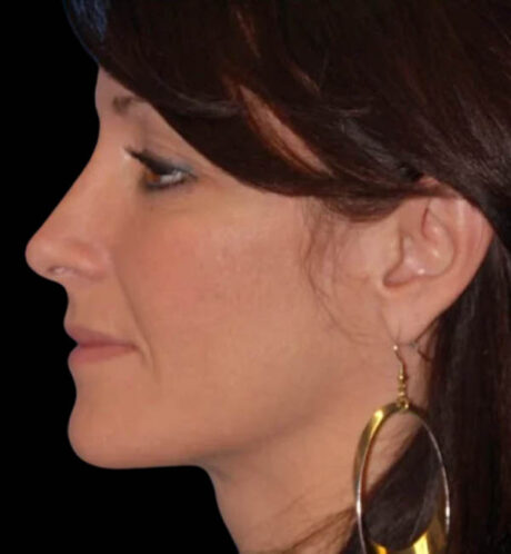 Rhinoplasty case #12747