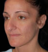 Rhinoplasty case #12747