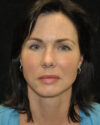 Blepharoplasty case #13859