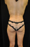 Brazilian Butt Lift case #13809