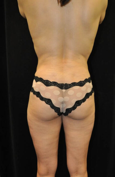 Brazilian Butt Lift case #13809