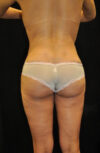 Brazilian Butt Lift case #13809