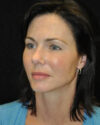 Blepharoplasty case #13859