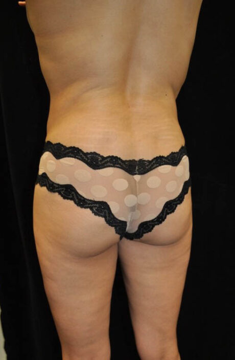 Brazilian Butt Lift case #13809