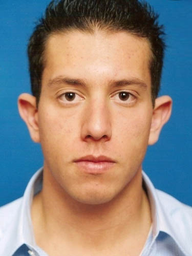 Otoplasty case #13867