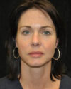 Blepharoplasty case #13859