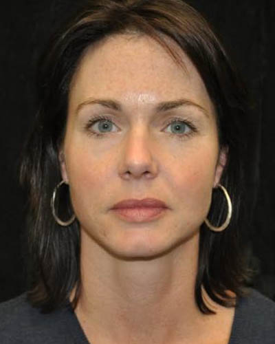Blepharoplasty case #13859