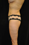 Brazilian Butt Lift case #13809