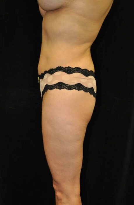 Brazilian Butt Lift case #13809