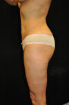 Brazilian Butt Lift case #13809