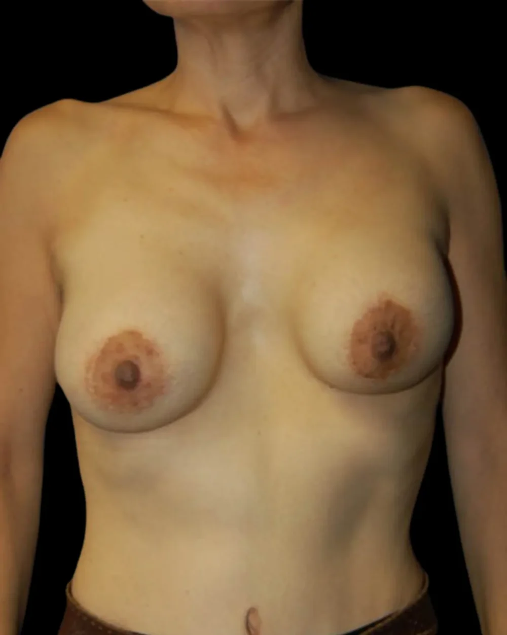 Breast Implant Revision case #13892