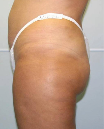 JuvaShape case #13883