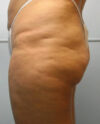 JuvaShape case #13883