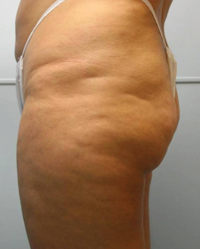 JuvaShape case #13883