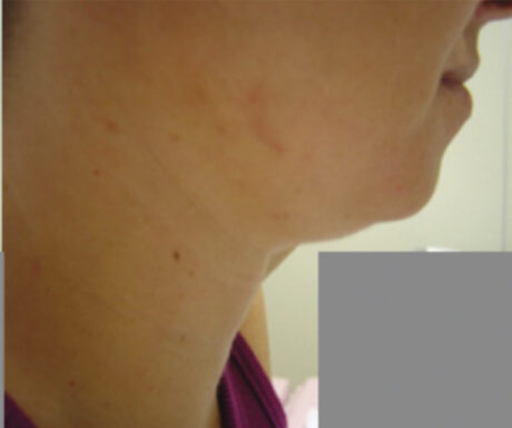 JuvaShape case #13886