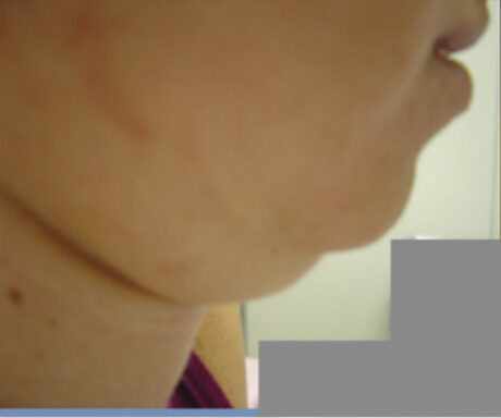 JuvaShape case #13886