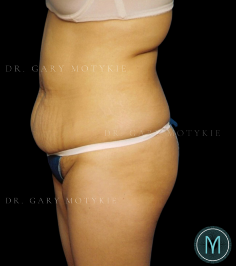 Tummy Tuck case #13899