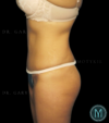 Tummy Tuck case #13899