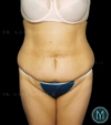 Tummy Tuck case #13899