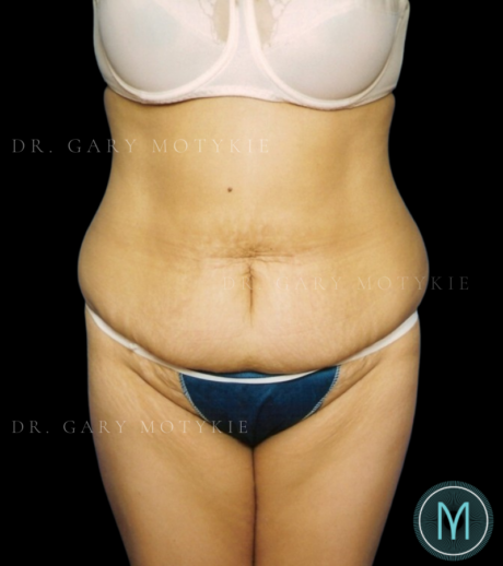 Tummy Tuck case #13899