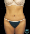 Tummy Tuck case #13899