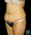 Tummy Tuck case #13899
