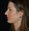Rhinoplasty case #13824