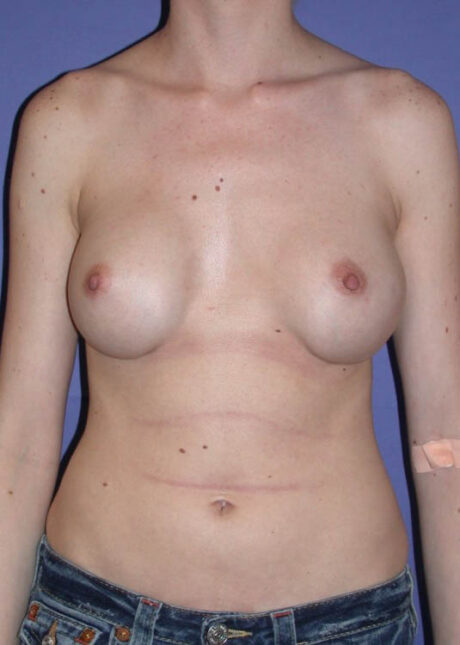 Breast Implant Revision case #13817