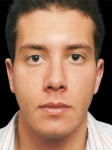 Otoplasty case #13867