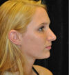 Rhinoplasty case #13827