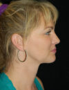 Facial Fat Grafting case #13804