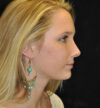 Rhinoplasty case #13827