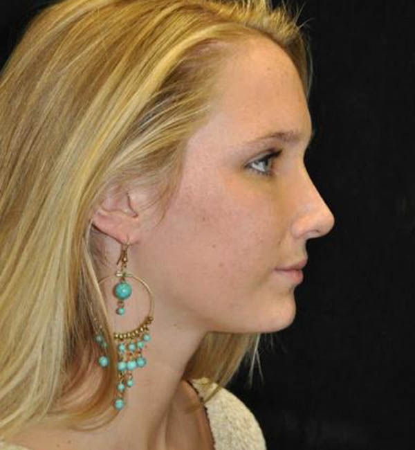 Rhinoplasty case #13827