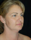 Facial Fat Grafting case #13804