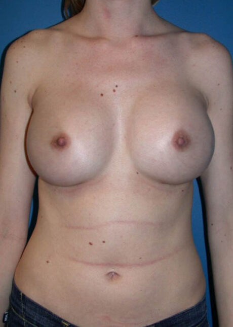 Breast Implant Revision case #13817