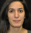 Rhinoplasty case #13830