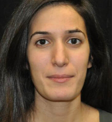 Rhinoplasty case #13830