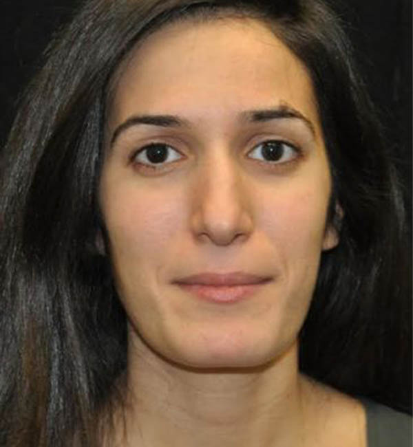 Rhinoplasty case #13830