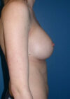 Breast Implant Revision case #13817