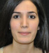 Rhinoplasty case #13830