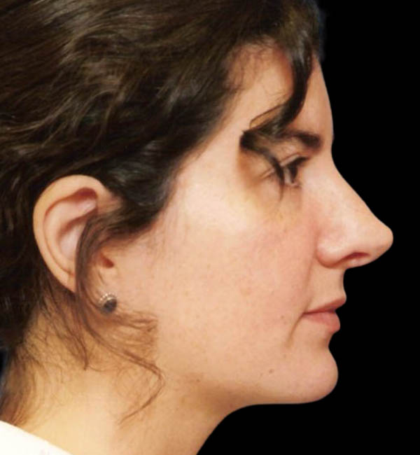 Revision Rhinoplasty case #13889