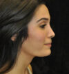 Rhinoplasty case #13830