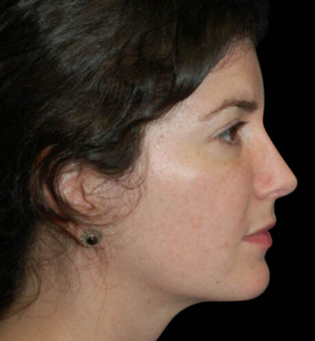 Revision Rhinoplasty case #13889